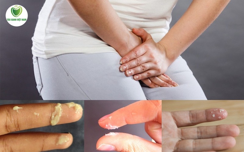 Củ cát lồi có thể điều trị khỏi một số bệnh phụ khoa điển hình do nấm và tạp khuẩn