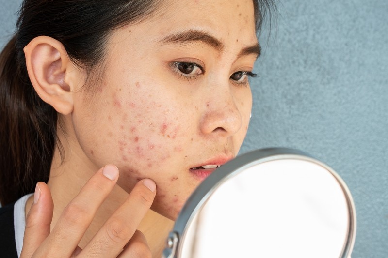 Làn da khỏe mạnh không mụn nhờ liệu pháp chăm sóc từ tinh dầu tràm trà