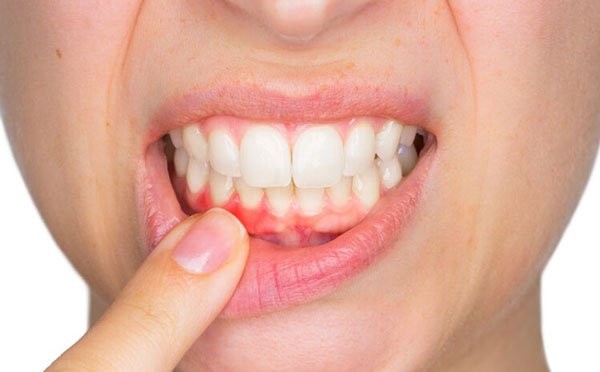 Dịch chiết từ cây cỏ ngọt có tác dụng điều trị các bệnh lý răng miệng hiệu quả
