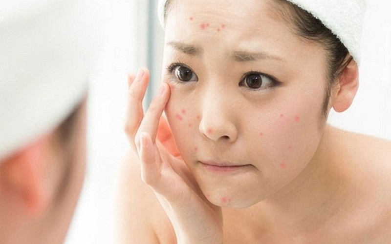 Dầu mù u giúp làm dịu và giảm sưng tấy các nốt mụn viêm