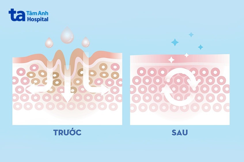 trị nám bằng laser